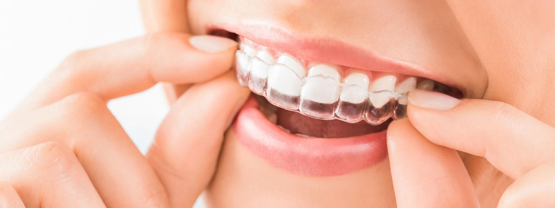 Invisalign dentistry